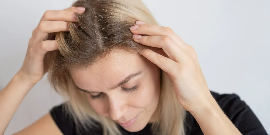 Close-up of a woman with visible dandruff in her hair