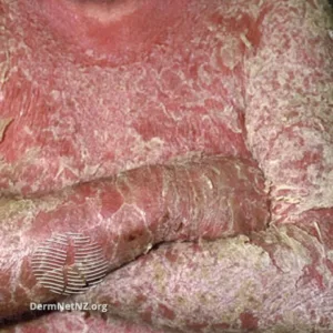 Erythrodermic Psoriasis