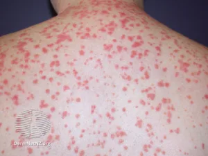 guttate psoriasis