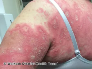 Pustular Psoriasis