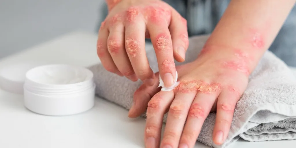 hands of patient suffering from psoriasis.