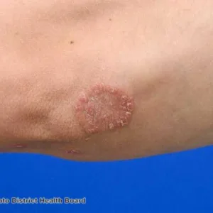 plaque psoriasis