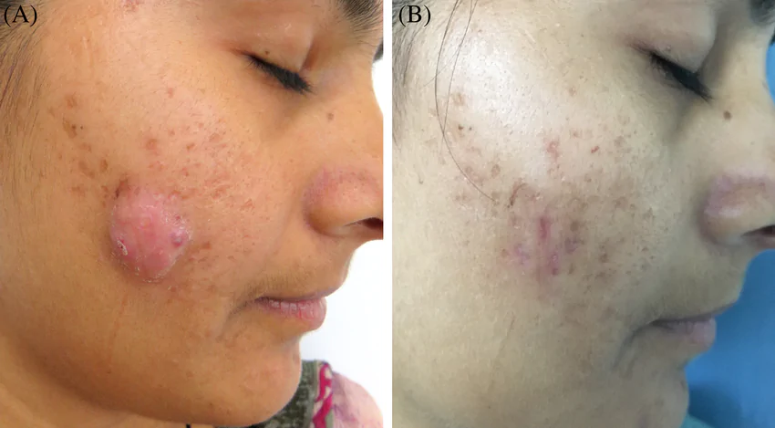 A-Pretreatment-photograph-of-cystic-acne-in-a-young-female-patient-B-Significant.