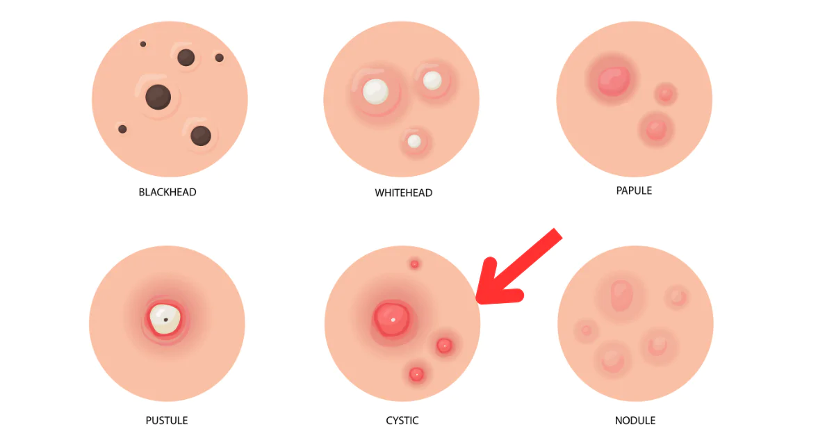 showing cystic acne among different types of acne.