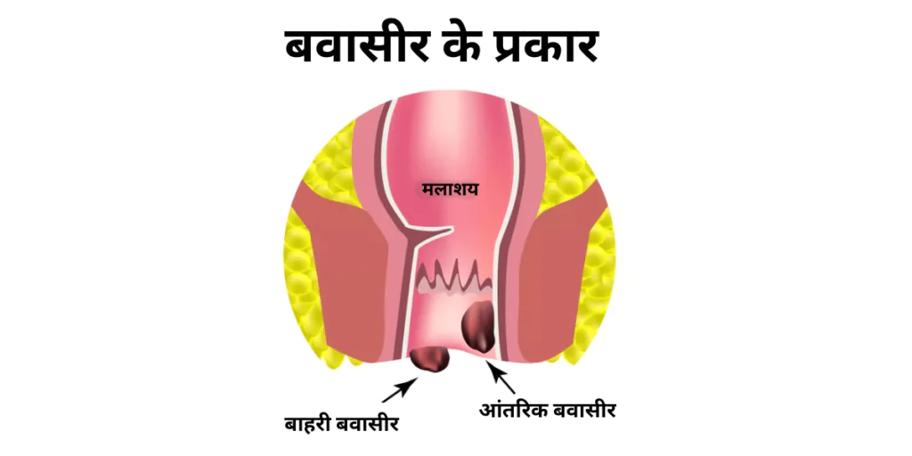 types of piles in hindi